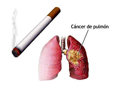 imagini cancerul pulmonar